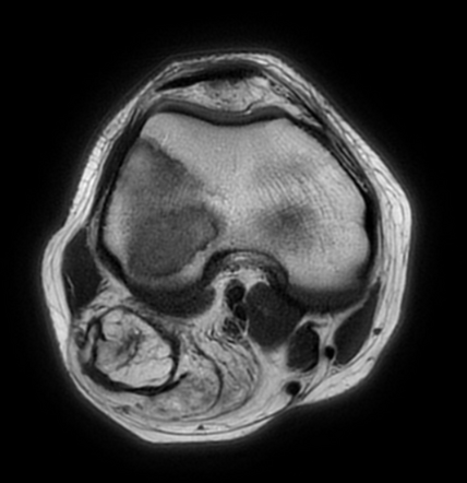 Popliteal subcutanous fibrolipoma mimicking atypical lipomatous tumor ...