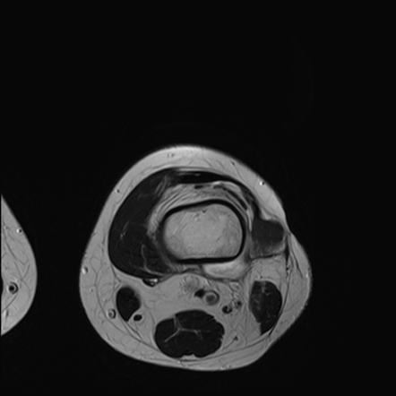 Chronic Osteomyelitis - Femur 