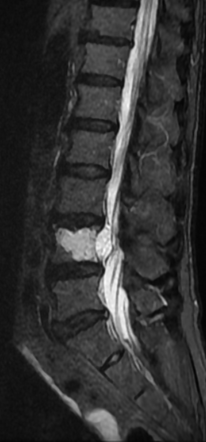 Vertebral chordoma | Radiology Case | Radiopaedia.org