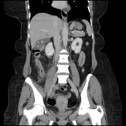 Acute appendicitis | Radiology Case | Radiopaedia.org