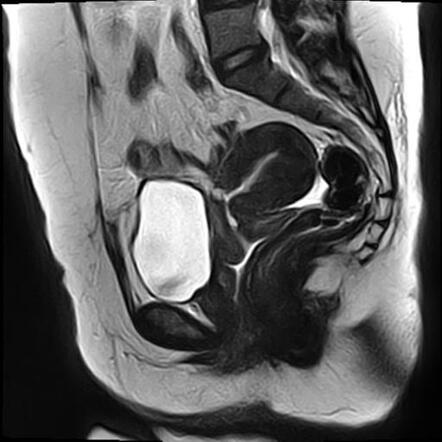 Diffuse uterine adenomyosis with ovarian fibromas and caesarean section ...