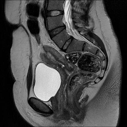 Uterine perforation with Asherman syndrome | Radiology Case ...