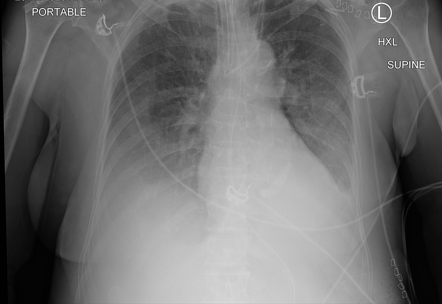 Mitral annular calcification | Radiology Case | Radiopaedia.org