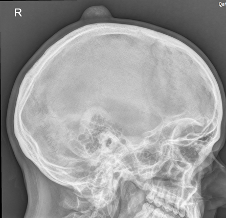 Trichilemmal cyst | Radiology Case | Radiopaedia.org