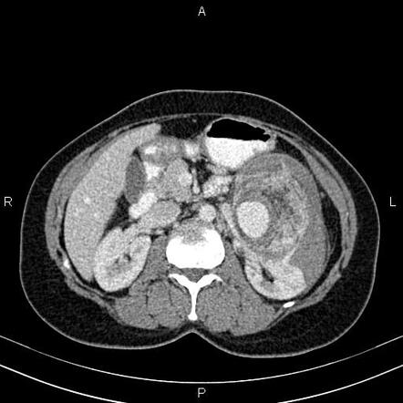 Wunderlich Syndrome With Pseudoaneurysm Due To Angiomyolipoma Rupture 