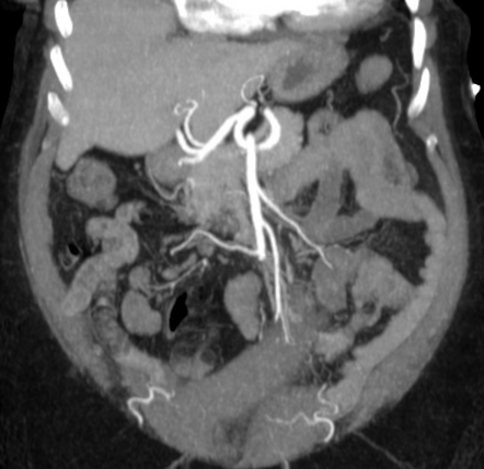 Acute mesenteric ischemia | Radiology Case | Radiopaedia.org