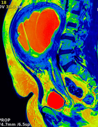 Large uterine leiomyoma with cystic degeneration | Radiology Case ...