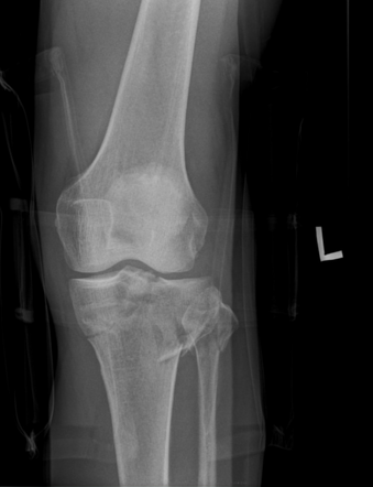 Schatzker Type V Tibial Plateau Fracture With Head Of Fibula Fracture 