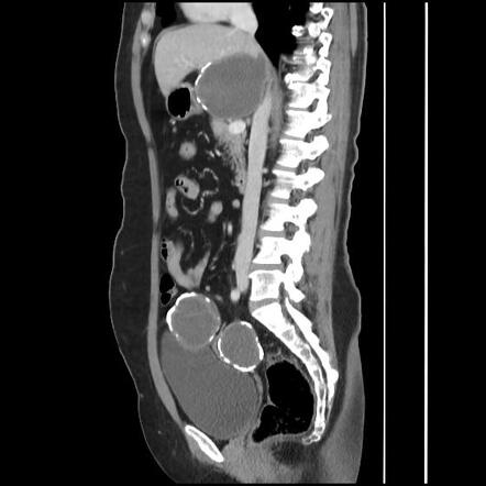 Calcified hepatic and pelvic hydatid cysts | Radiology Case ...