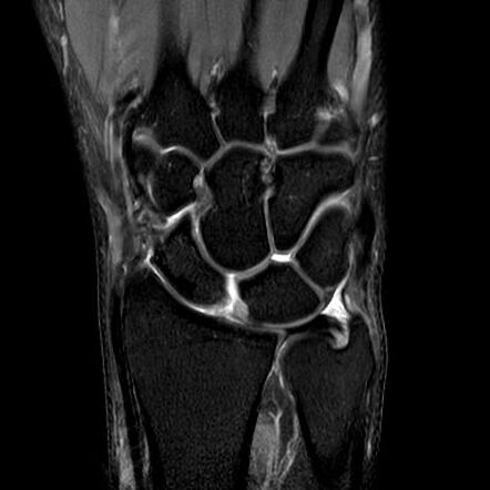 Isolated scapholunate ligament tear | Radiology Case | Radiopaedia.org