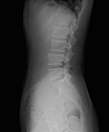 Limbus vertebra | Radiology Case | Radiopaedia.org