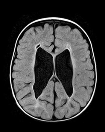 Periventricular leukomalacia | Radiology Case | Radiopaedia.org