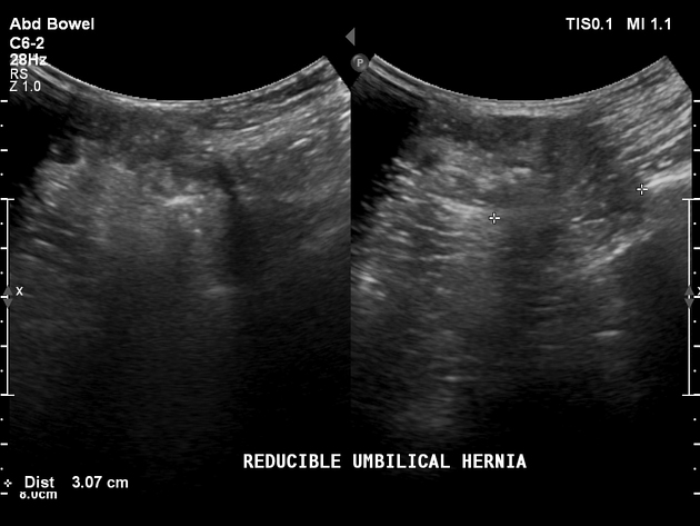 Congenital umbilical hernia, Radiology Case