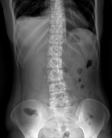 Common bile duct stricture with stones | Radiology Case | Radiopaedia.org