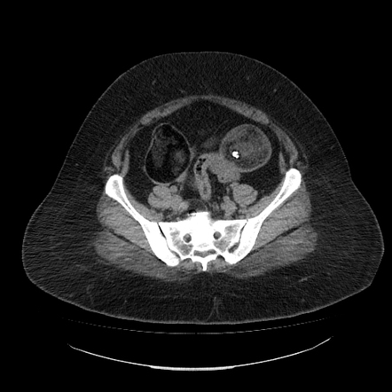 Bilateral ovarian dermoid cyst and CT detector artifact | Radiology ...