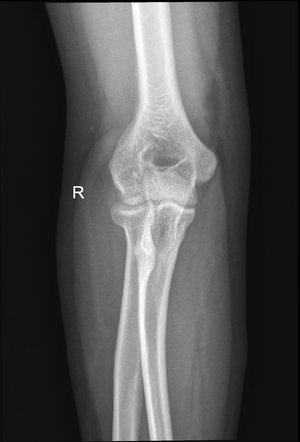 Radial head fracture | Radiology Case | Radiopaedia.org