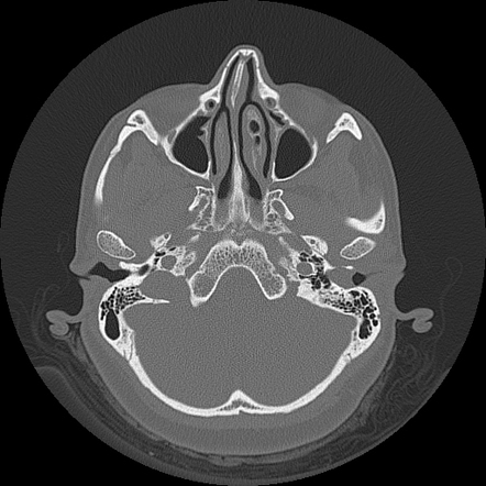 External auditory canal cholesteatoma | Radiology Case | Radiopaedia.org