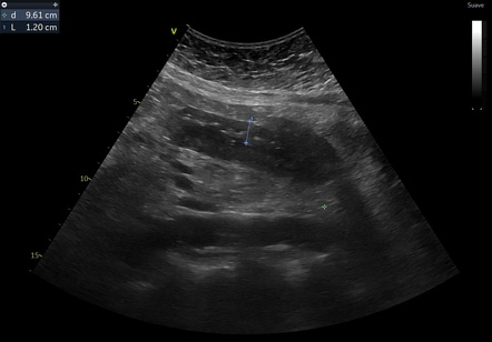 Pneumatosis Intestinalis 