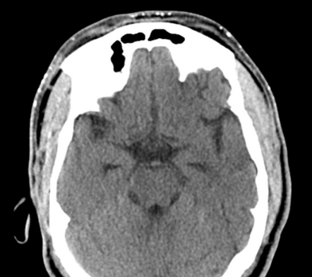 Benign miliary osteoma cutis of the face | Radiology Case | Radiopaedia.org