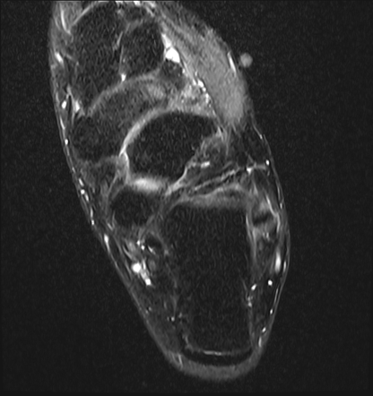 Müller-Weiss syndrome | Radiology Case | Radiopaedia.org