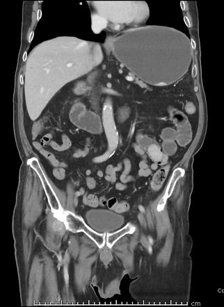 Gallstone ileus | Radiology Case | Radiopaedia.org