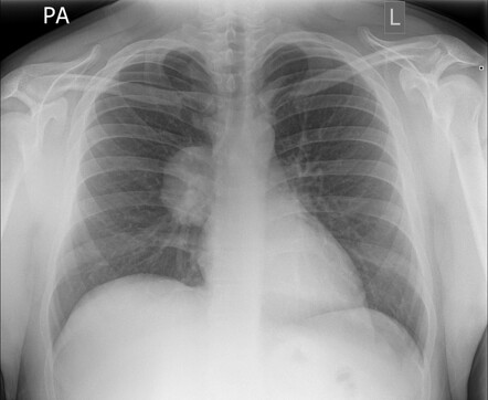 Hilum overlay sign | Radiology Case | Radiopaedia.org