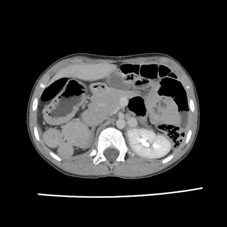 Polysplenia syndrome | Radiology Case | Radiopaedia.org