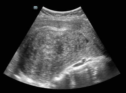 Uterine adenomyosis | Radiology Case | Radiopaedia.org