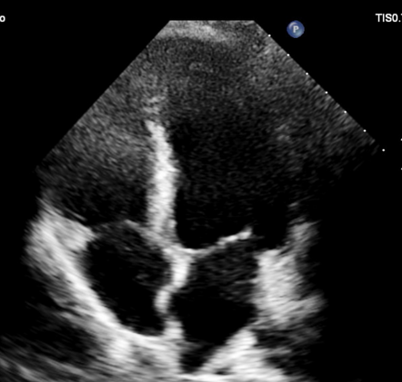 Atrial septal aneurysm | Radiology Case | Radiopaedia.org