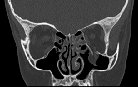 Trapdoor fracture | Radiology Reference Article | Radiopaedia.org