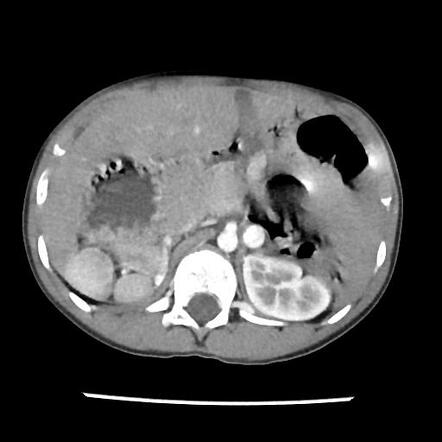 Polysplenia syndrome | Radiology Case | Radiopaedia.org