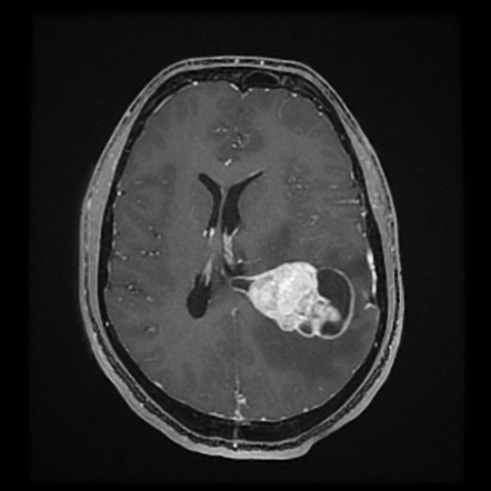 Supratentorial Ependymoma 