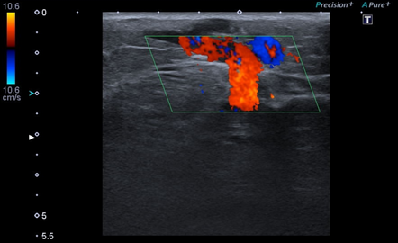 Secondary varicose veins | Radiology Case | Radiopaedia.org