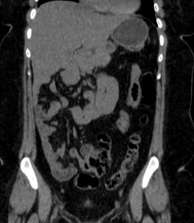 Intestinal non-rotation | Radiology Case | Radiopaedia.org