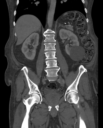 Simple renal cyst | Radiology Case | Radiopaedia.org