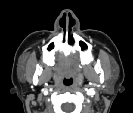 Accessory parotid gland | Radiology Case | Radiopaedia.org