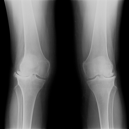 Osteoarthrosis - knee | Radiology Case | Radiopaedia.org