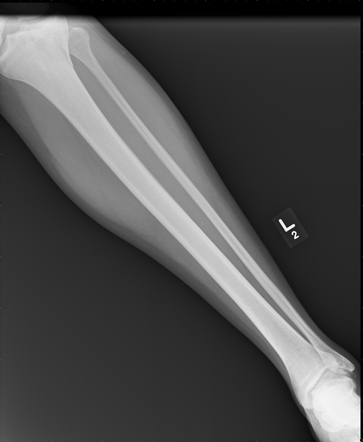 Tibial Plateau Fracture - Schatzker 2 | Radiology Case | Radiopaedia.org