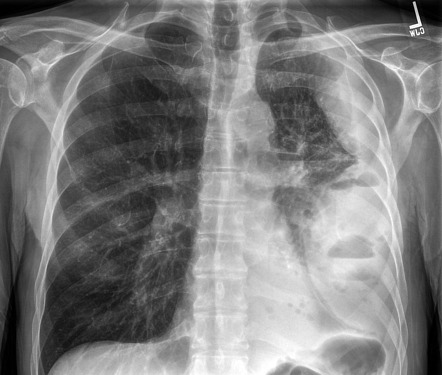 Empyema | Radiology Case | Radiopaedia.org