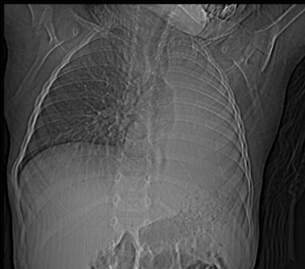 White-out hemithorax (left side) | Radiology Case | Radiopaedia.org