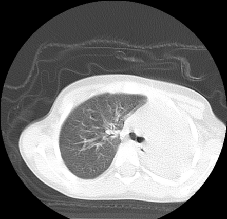 White-out hemithorax (left side) | Radiology Case | Radiopaedia.org