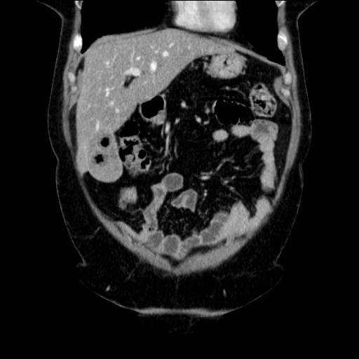 Gas in gallstones | Image | Radiopaedia.org