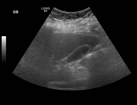 Gallbladder polyp | Radiology Case | Radiopaedia.org