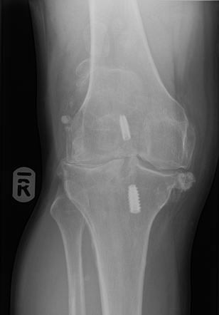 Knee osteoarthritis - intra-articular bodies | Radiology Case ...