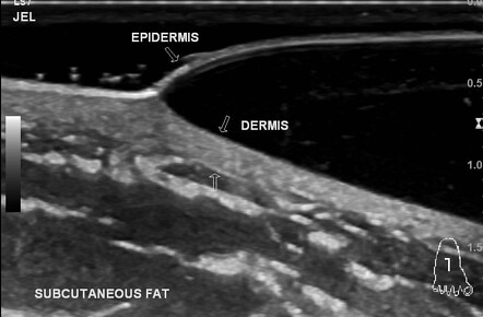 Skin blister (ultrasound) | Radiology Case | Radiopaedia.org