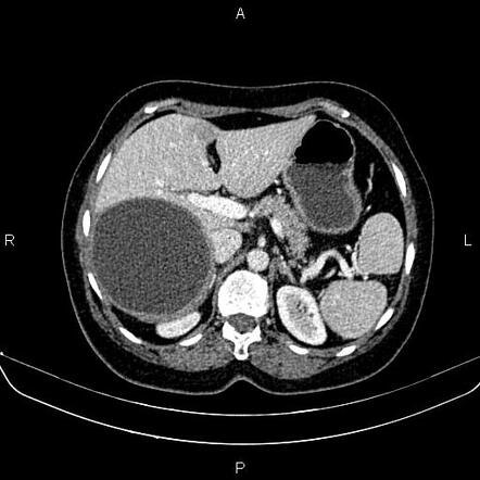 Bipartite spleen | Radiology Case | Radiopaedia.org