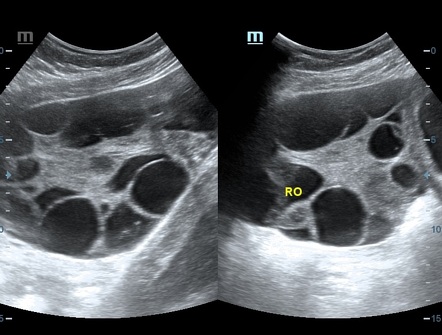 Theca lutein cysts | Radiology Case | Radiopaedia.org