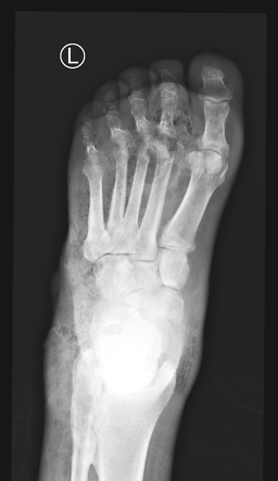 Gas gangrene of foot | Radiology Case | Radiopaedia.org