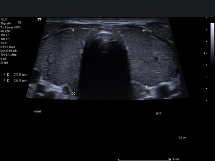 Thyroid inferno( Graves disease) | Radiology Case | Radiopaedia.org