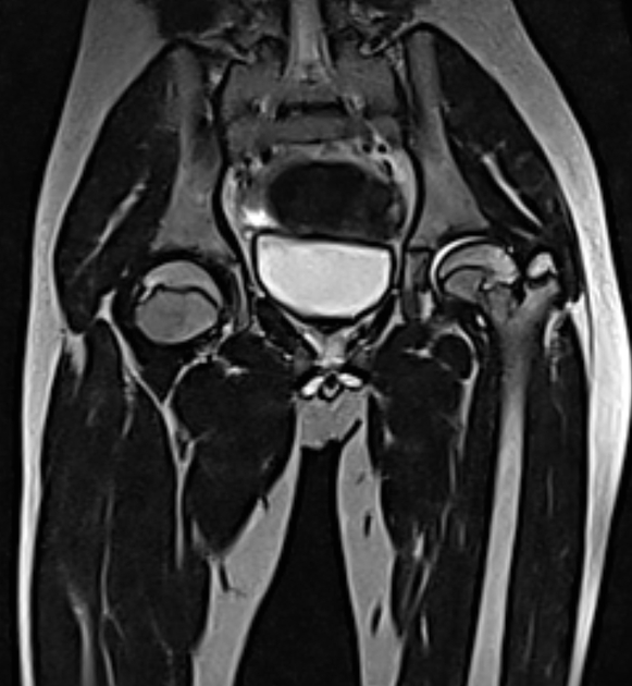 Osteochondrodysplasia of the femoral neck | Radiology Case 